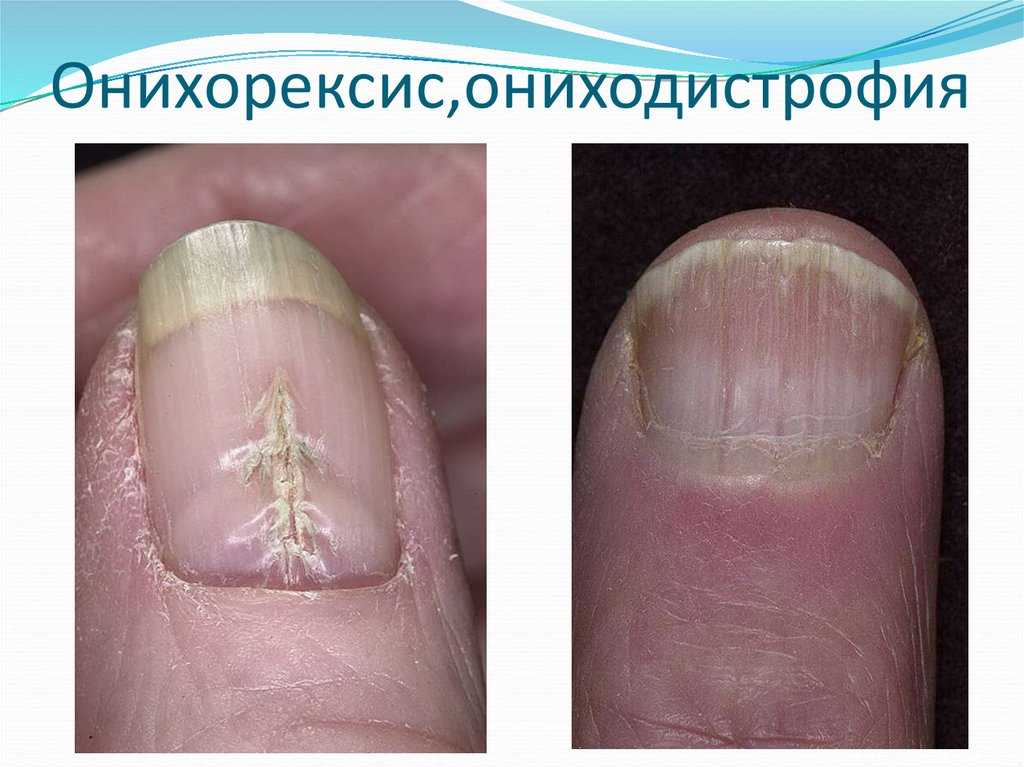 Корки в носу — лечение у взрослых, что делать при образовании сухости и кровяных корок